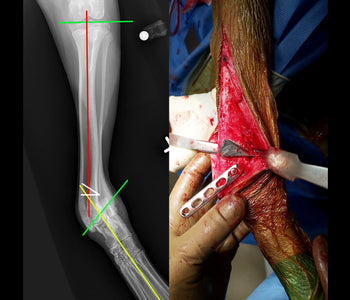 CrossCut Wedge Osteotomy Guides