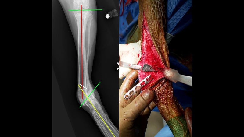 CrossCut Wedge Osteotomy Guides