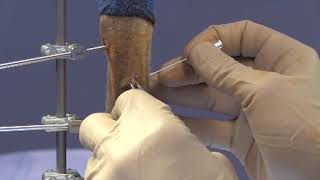 SK ESF System | Determining Bone Depth