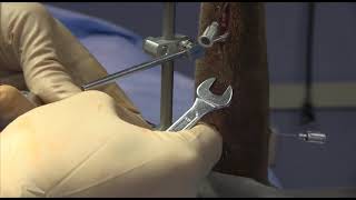 SK ESF System | Two-Wrench Counter Torque