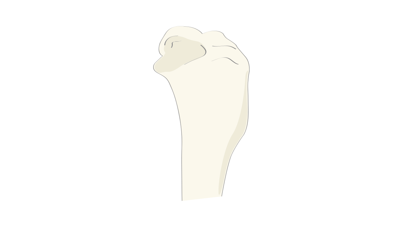 CrossCut Wedge Osteotomy Guide