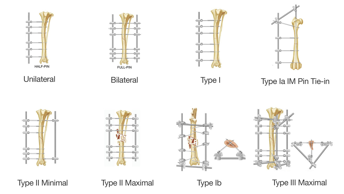 Difference Between Fixation And Stabilization at Lester Shippy blog