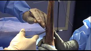 SK ESF System | Soft Tissue Release Incisions